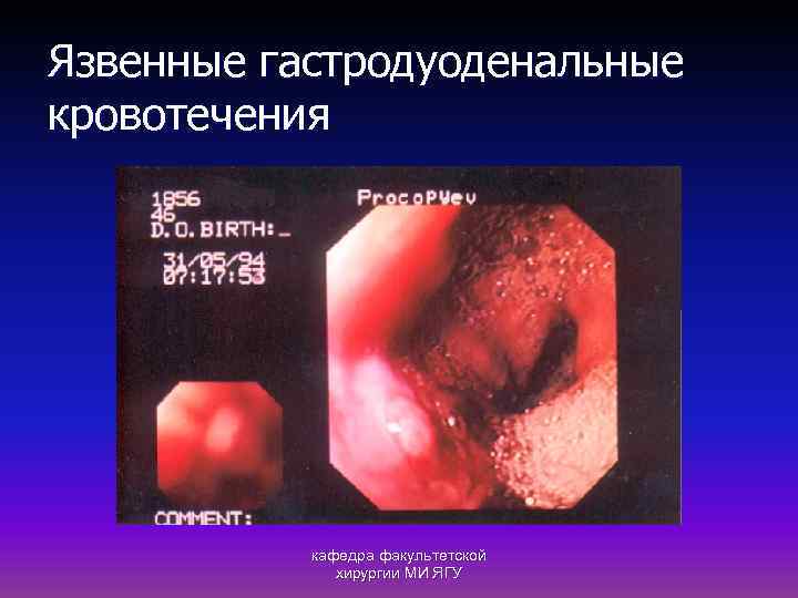 Язвенные гастродуоденальные кровотечения кафедра факультетской хирургии МИ ЯГУ 