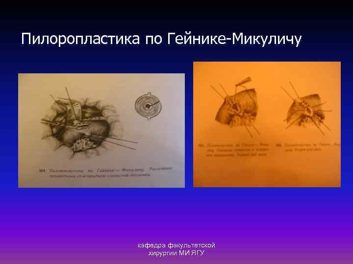 Пилоропластика по Гейнике-Микуличу кафедра факультетской хирургии МИ ЯГУ 