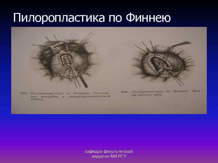 Пилоропластика по Финнею кафедра факультетской хирургии МИ ЯГУ 