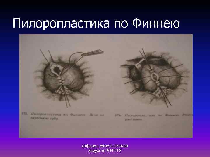 Пилоропластика по Финнею кафедра факультетской хирургии МИ ЯГУ 