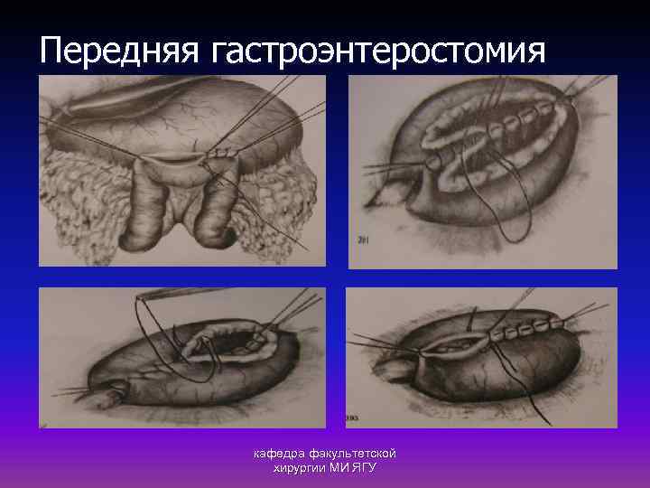 Передняя гастроэнтеростомия кафедра факультетской хирургии МИ ЯГУ 