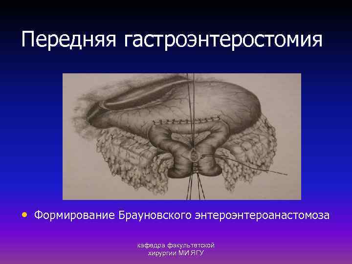 Передняя гастроэнтеростомия • Формирование Брауновского энтероанастомоза кафедра факультетской хирургии МИ ЯГУ 