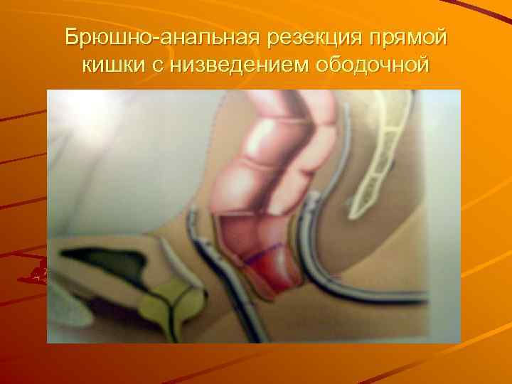 Брюшно-анальная резекция прямой кишки с низведением ободочной 