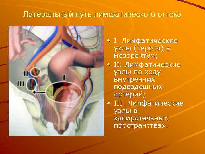 Латеральный путь лимфатического оттока I. Лимфатические узлы (Герота) в мезоректум; II. Лимфатические узлы по