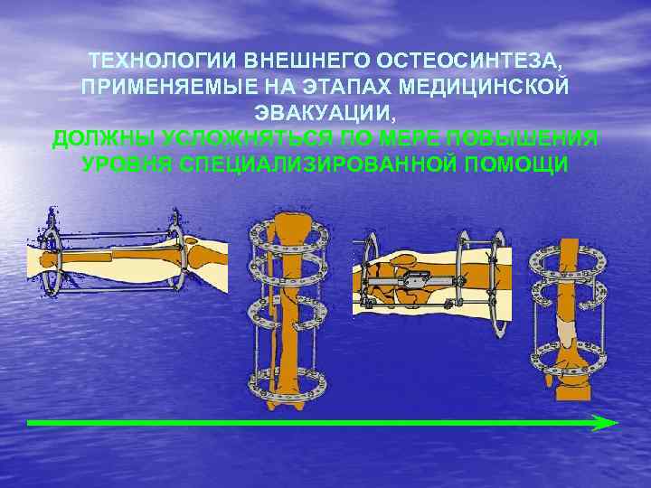 ТЕХНОЛОГИИ ВНЕШНЕГО ОСТЕОСИНТЕЗА, ПРИМЕНЯЕМЫЕ НА ЭТАПАХ МЕДИЦИНСКОЙ ЭВАКУАЦИИ, ДОЛЖНЫ УСЛОЖНЯТЬСЯ ПО МЕРЕ ПОВЫШЕНИЯ УРОВНЯ