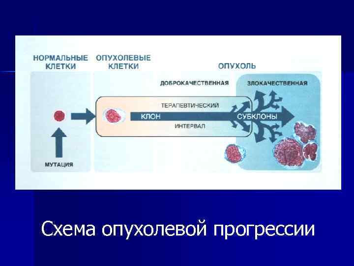 Схема опухолевой прогрессии 