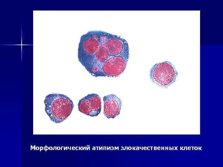 Морфологический атипизм злокачественных клеток 