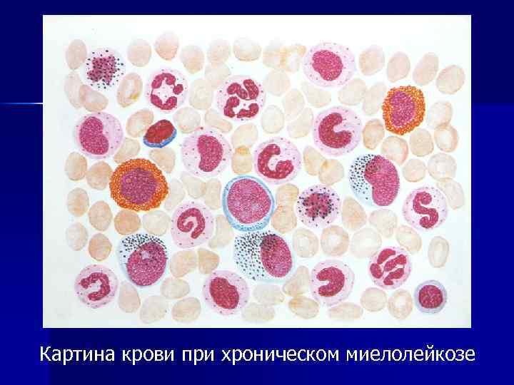 Хронический миелолейкоз у детей презентация