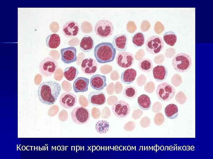 Кровь при лимфолейкозе