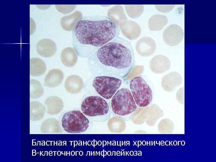 Бластная трансформация хронического В-клеточного лимфолейкоза 