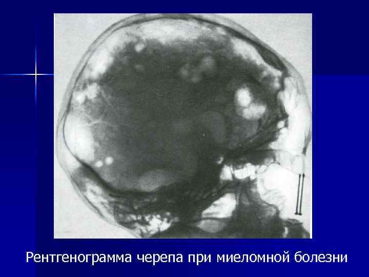 Рентгенограмма черепа при миеломной болезни 