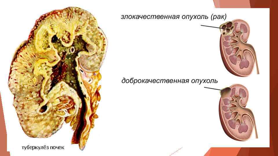 туберкулёз почек 