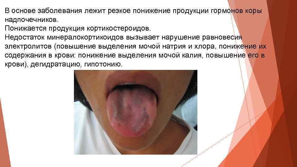В основе заболевания лежит резкое понижение продукции гормонов коры надпочечников. Понижается продукция кортикостероидов. Недостаток