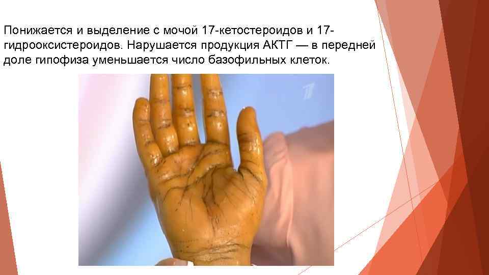 Понижается и выделение с мочой 17 -кетостероидов и 17 гидрооксистероидов. Нарушается продукция АКТГ —