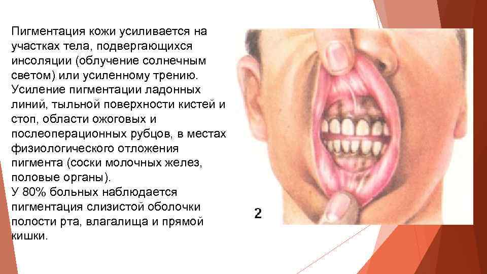 Пигментация кожи усиливается на участках тела, подвергающихся инсоляции (облучение солнечным светом) или усиленному трению.