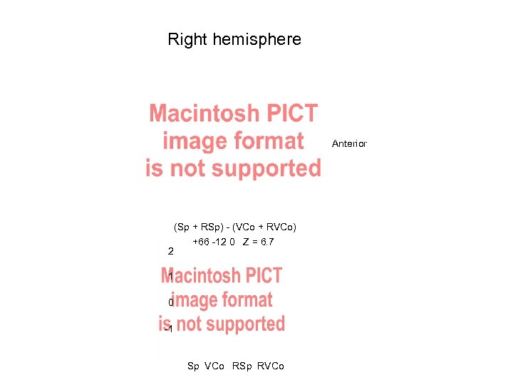 Right hemisphere Anterior 2 (Sp + RSp) - (VCo + RVCo) +66 -12 0