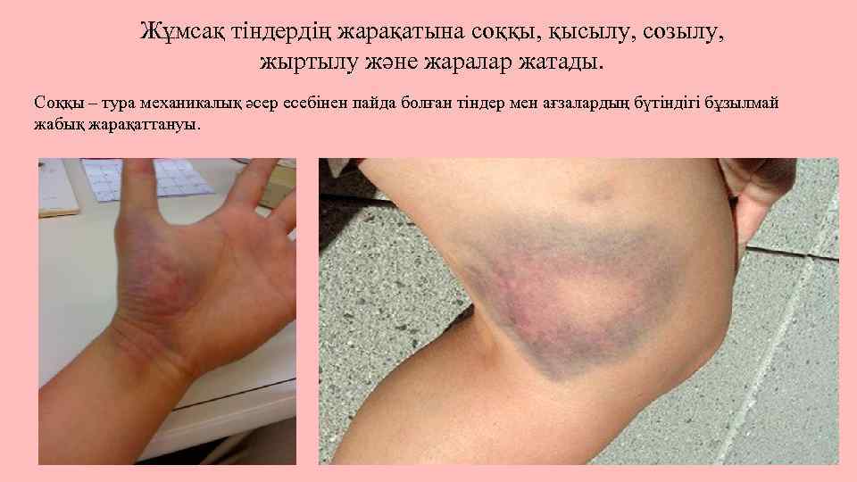 Жұмсақ тіндердің жарақатына соққы, қысылу, созылу, жыртылу және жаралар жатады. Соққы – тура механикалық