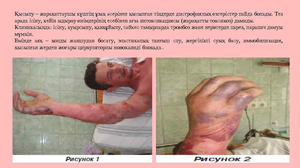 Қысылу – жарақаттаушы күштің ұзақ әсерінен қысылған тіндерде дистрофиялық өзгерістер пайда болады. Тез арада