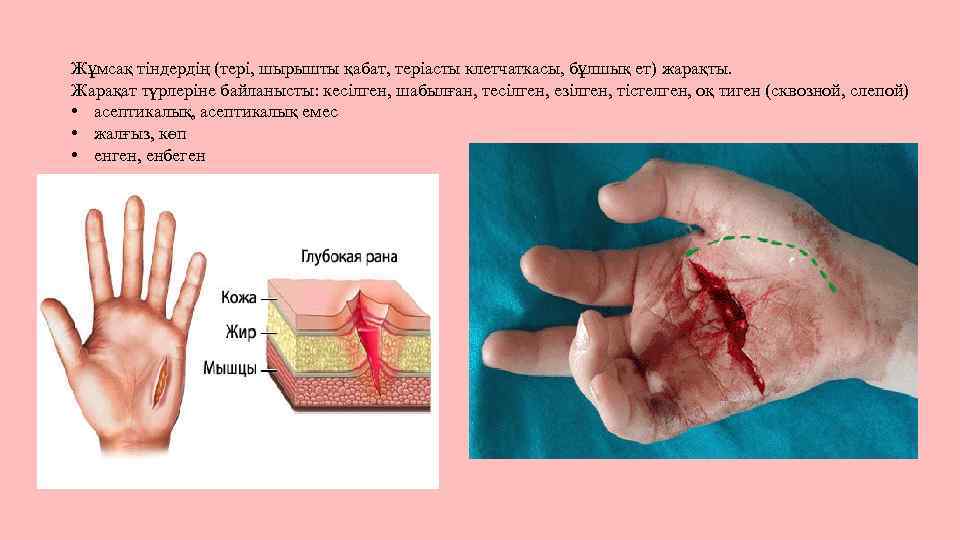 Жұмсақ тіндердің (тері, шырышты қабат, теріасты клетчаткасы, бұлшық ет) жарақты. Жарақат түрлеріне байланысты: кесілген,