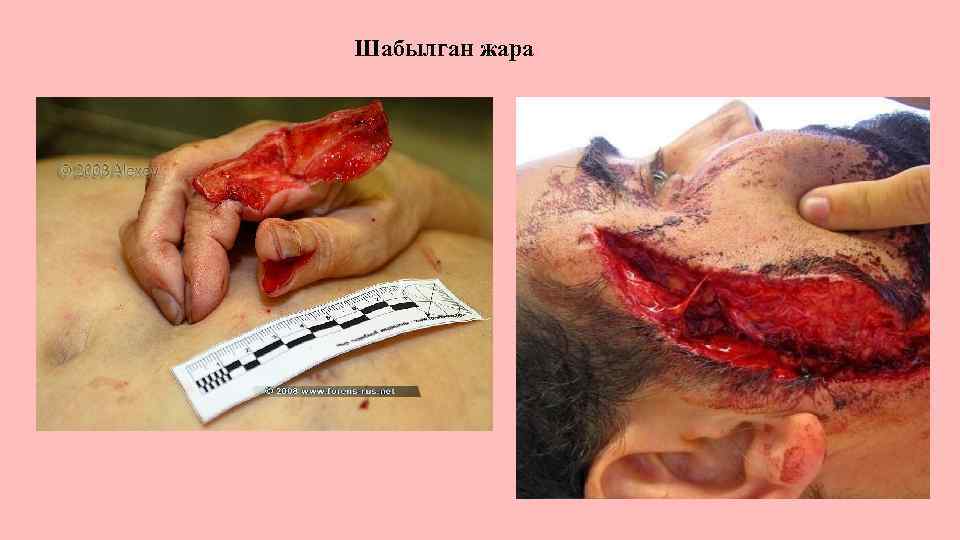 Шабылган жара 