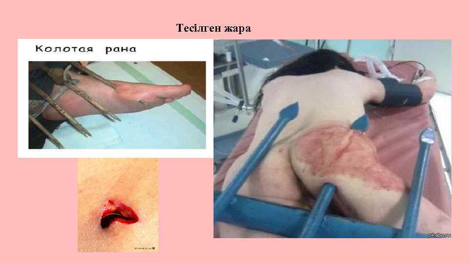 Тесілген жара 