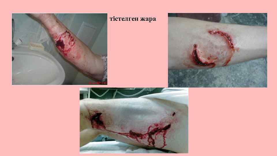 тістелген жара 