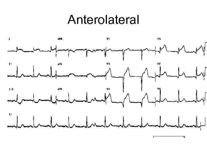 Anterolateral 