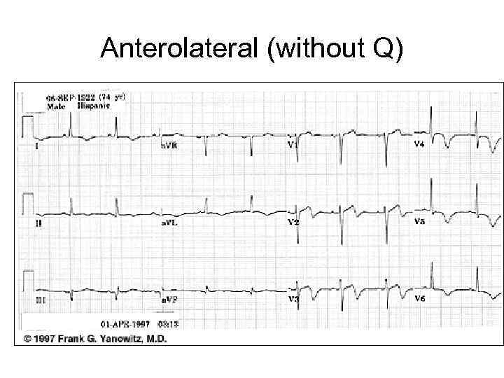 Anterolateral (without Q) 