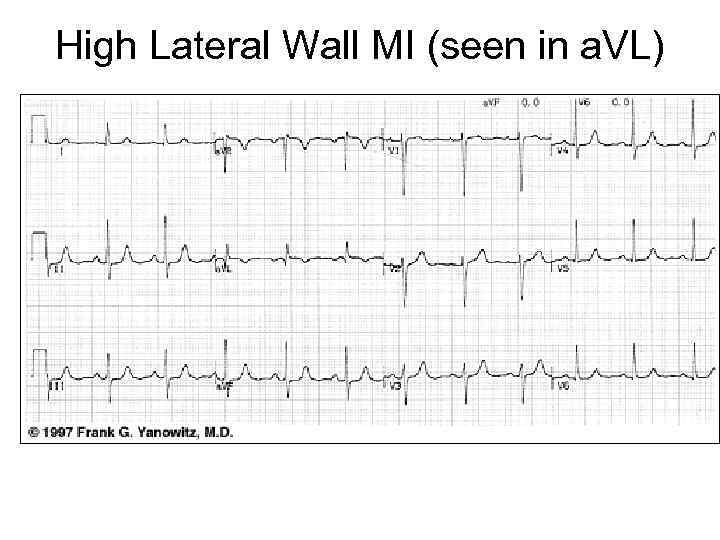 High Lateral Wall MI (seen in a. VL) 