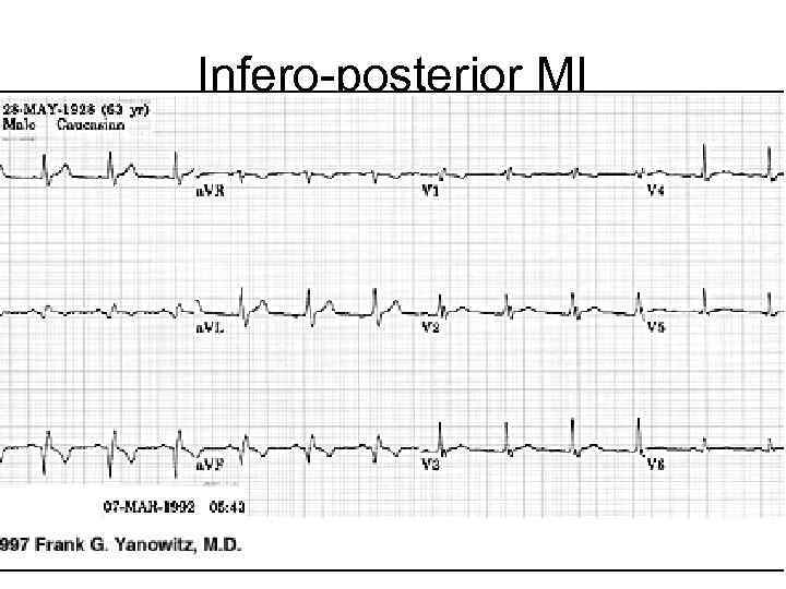 Infero-posterior MI 