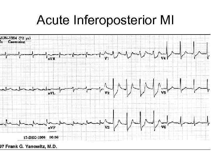 Acute Inferoposterior MI 