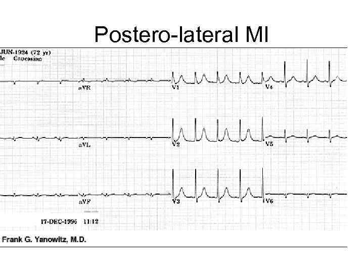 Postero-lateral MI 