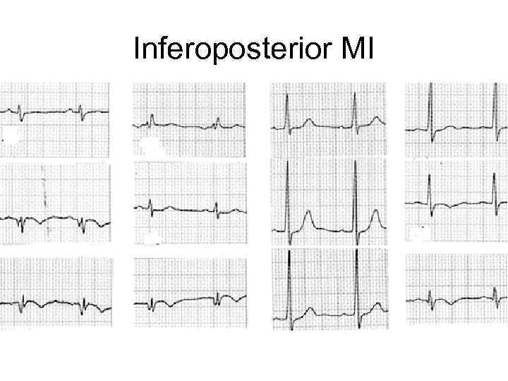 Inferoposterior MI 