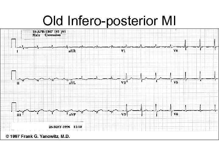 Old Infero-posterior MI 