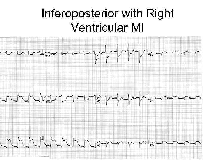 Inferoposterior with Right Ventricular MI 