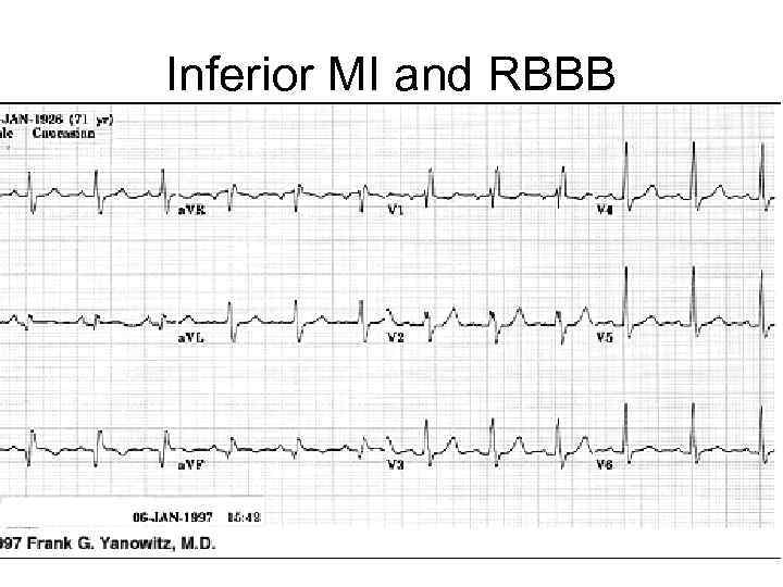 Inferior MI and RBBB 