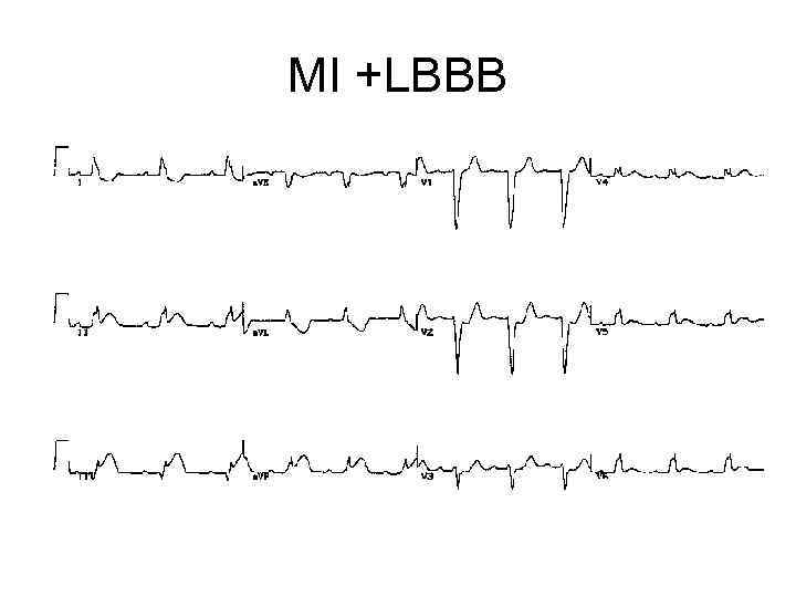 MI +LBBB 