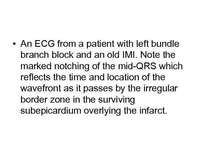  • An ECG from a patient with left bundle branch block and an