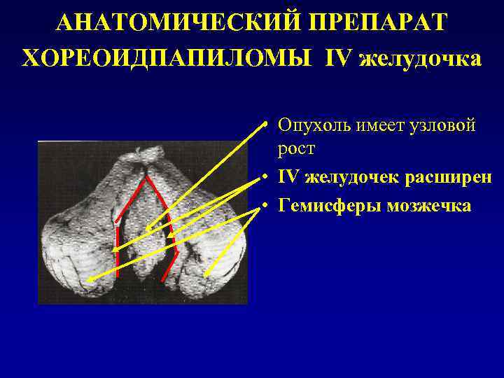 АНАТОМИЧЕСКИЙ ПРЕПАРАТ ХОРЕОИДПАПИЛОМЫ IV желудочка • Опухоль имеет узловой рост • IV желудочек расширен