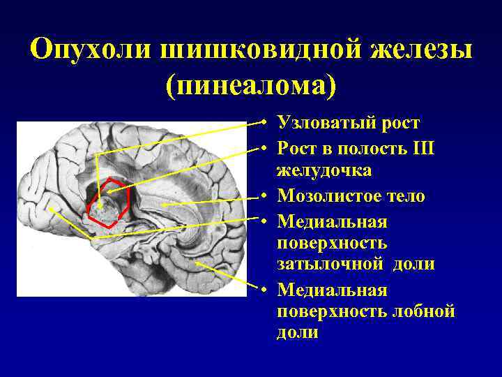 Киста шишковидной железы железа. Пинеалома это опухоль эпифиза. Пинеалома опухоль шишковидной железы. Опухоль шишковидного тела в головном мозге.