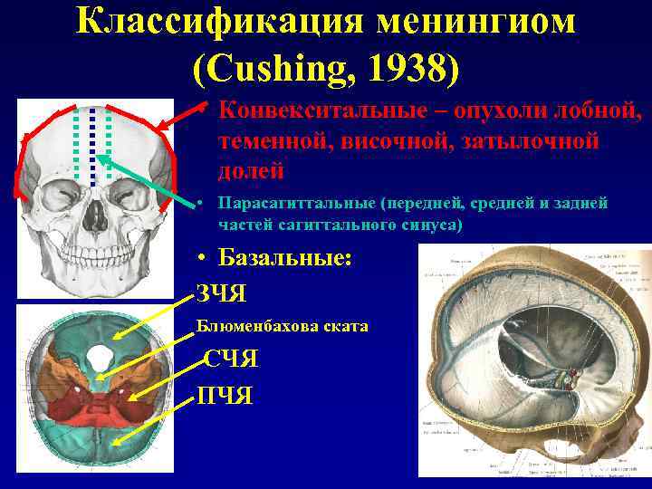 Классификация менингиом (Cushing, 1938) • Конвекситальные – опухоли лобной, теменной, височной, затылочной долей •