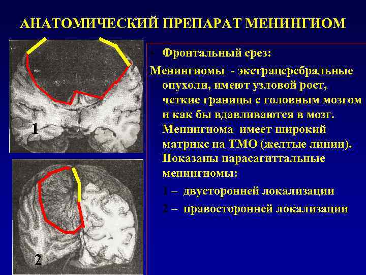 Менингиома головного мозга форум