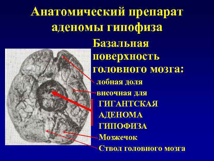 Аденома гипофиз мозга что это такое. Гипофиз на препарате анатомия. Анатомический препарат мозга. Базальная аденома гипофиза. Микроаденомы гипофиза головного мозга.