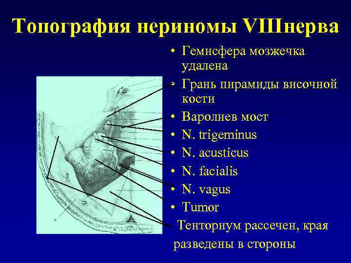 Топография нериномы VIIIнерва • Гемисфера мозжечка удалена • Грань пирамиды височной кости • Варолиев