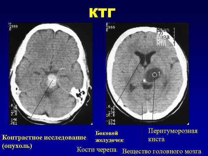 Кисты желудочков