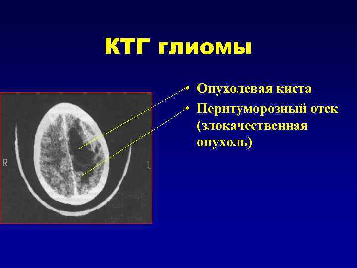 КТГ глиомы • Опухолевая киста • Перитуморозный отек (злокачественная опухоль) 