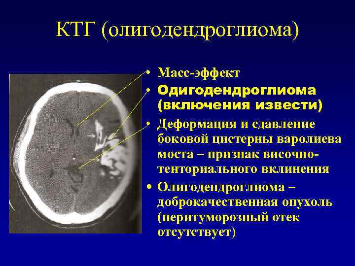 КТГ (олигодендроглиома) • Масс-эффект • Одигодендроглиома (включения извести) • Деформация и сдавление боковой цистерны