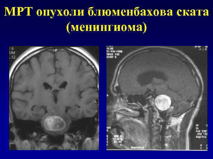 МРТ опухоли блюменбахова ската (менингиома) 