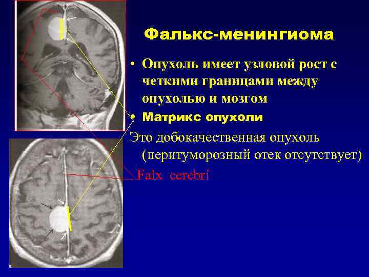 Объемное образования мозга мкб. Петрифицированная менингиома. Микрокистозная менингиома. Менингиома серповидного отростка.