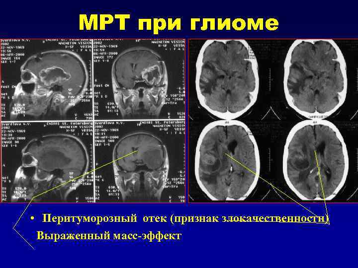 МРТ при глиоме • Перитуморозный отек (признак злокачественности) Выраженный масс-эффект 